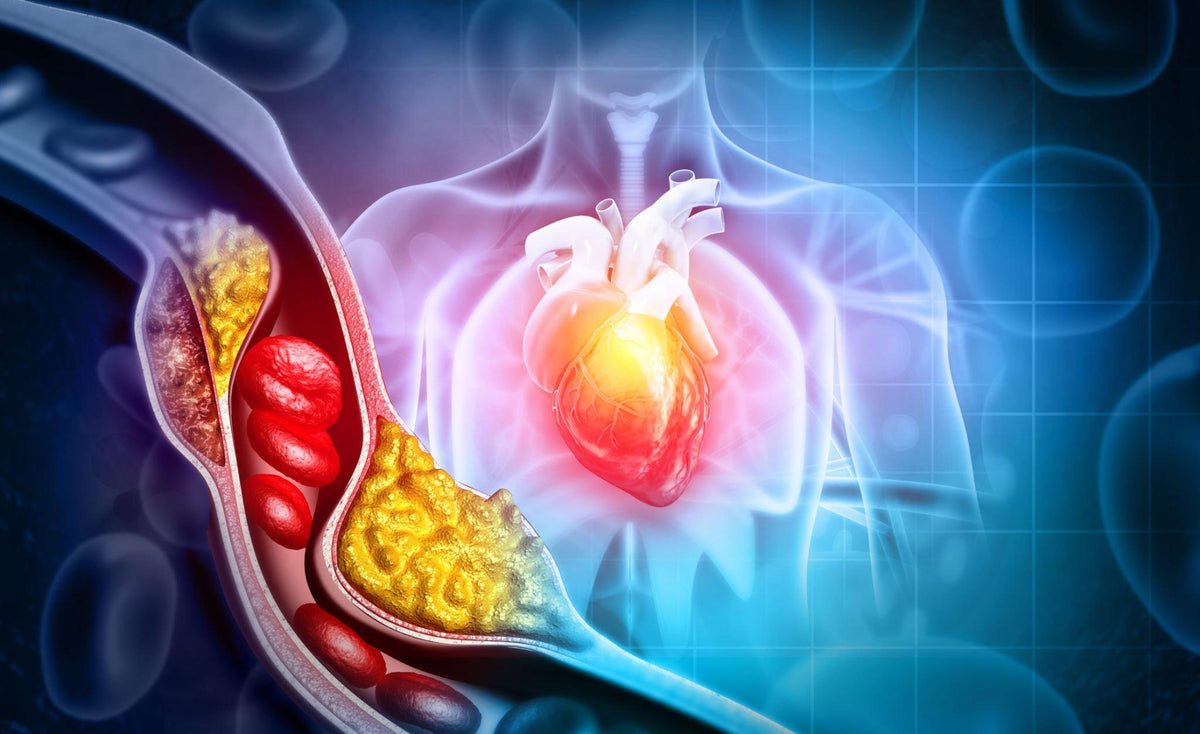 Arteriosclerosis