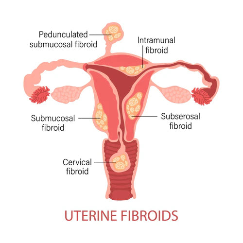 Fibroids