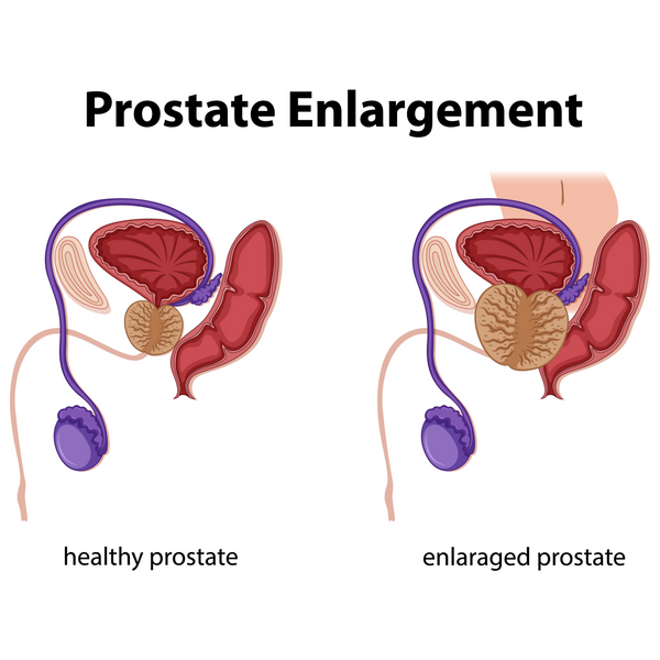 Enlarged Prostate