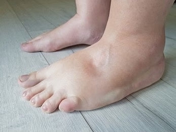 Edema