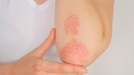 Psoriasis