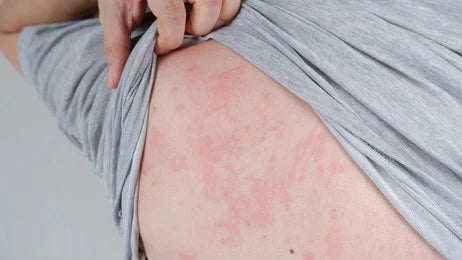 Urticaria