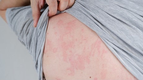 Urticaria